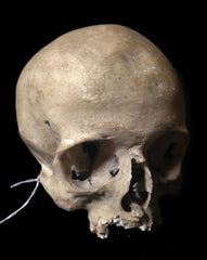 Pathological Real Human Skulls