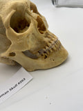 A Real Uncut Human Skull With Cracked Calvarium #263