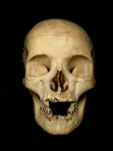 Mild Plagiocephaly Human Skull
