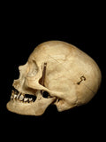 Mild Plagiocephaly Human Skull